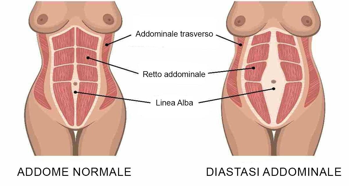 DIASTASI ADDOMINALE | cos'è, sintomi, gli esercizi da fare e quelli da evitare DIASTASI ADDOMINALE | cos'è, sintomi, gli esercizi da fare e quelli da evitare