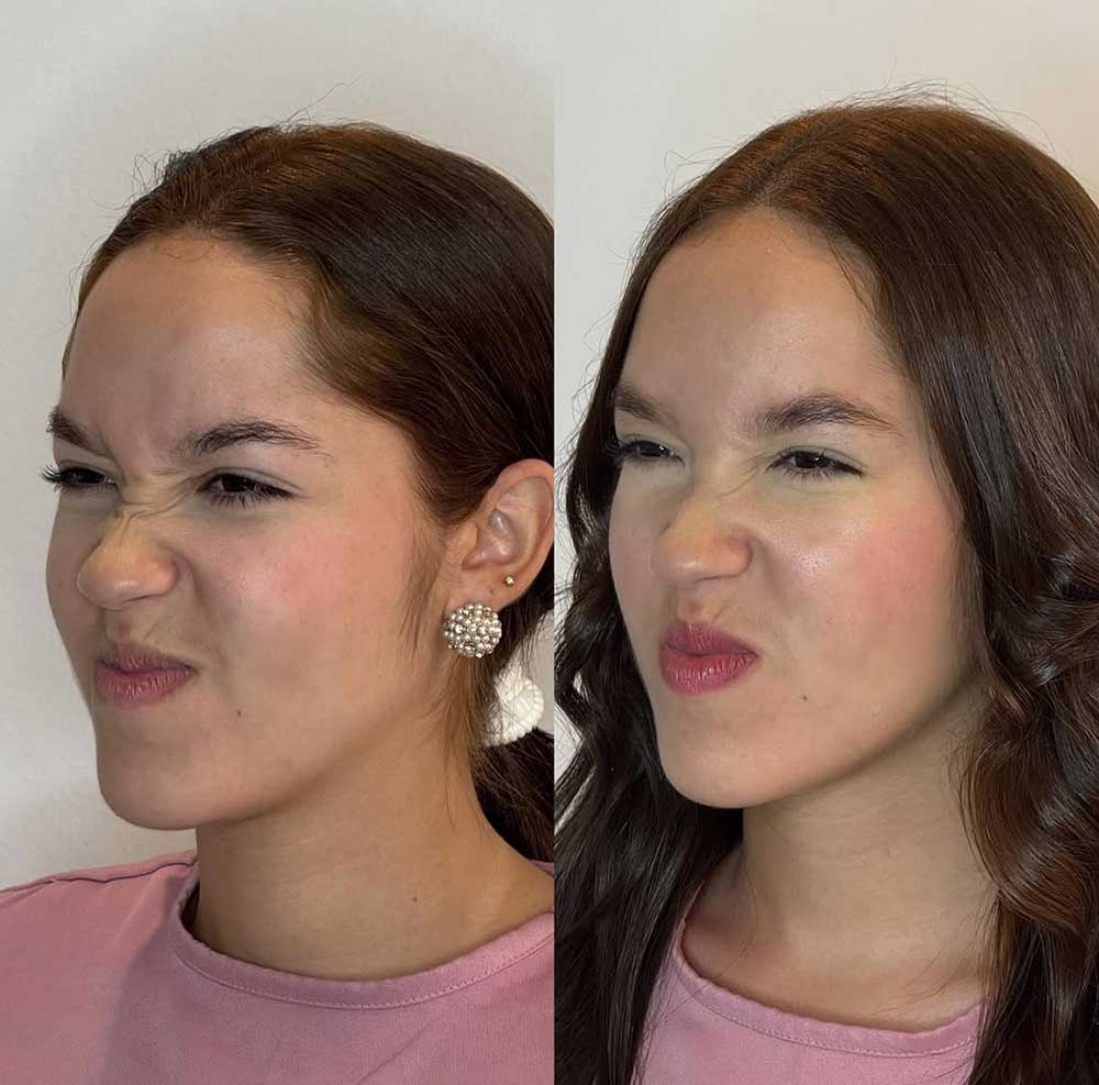 Baby botox prima e dopo Baby botox prima e dopo