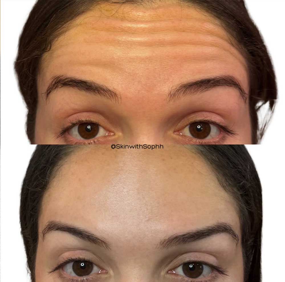Baby Botox prima e dopo Baby Botox prima e dopo