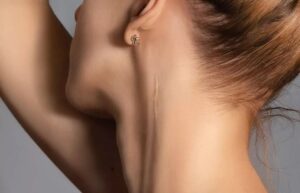 Cicatrice ipertrofica