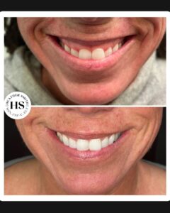 Botox labbra Botox labbra